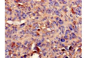 Immunohistochemistry of paraffin-embedded human melanoma using ABIN7169242 at dilution of 1:100 (PPP2R2A antibody  (Regulatory Subunit B))