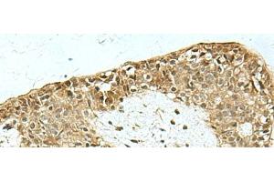 Immunohistochemistry of paraffin-embedded Human breast cancer tissue using KAT7 Polyclonal Antibody at dilution of 1:55(x200) (MYST2 antibody)