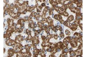 ABIN6268658 at 1/100 staining human liver cancer tissues sections by IHC-P. (PIK3CA antibody  (Internal Region))