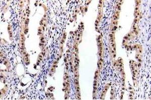 Immunohistochemistry (IHC) analyzes of p-STAT-5A antibody in paraffin-embedded human lung carcinoma tissue. (STAT5A antibody  (pSer780))