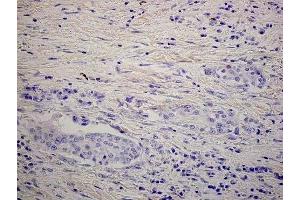 Human lung cancer (formalin-fixed, paraffin embedded) stained with human lumican antibody. (LUM antibody  (AA 211-227))