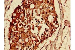 Immunohistochemistry of paraffin-embedded human breast cancer using ABIN7159021 at dilution of 1:100 (MAS1L antibody  (AA 318-378))