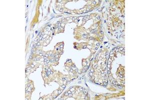 Immunohistochemistry of paraffin-embedded human prostate using CFD antibody (ABIN5974492) at dilution of 1/100 (40x lens). (Adipsin antibody)