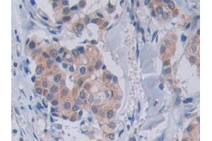 Detection of SEMA3A in Human Breast cancer Tissue using Polyclonal Antibody to Semaphorin 3A (SEMA3A) (SEMA3A antibody  (AA 580-664))
