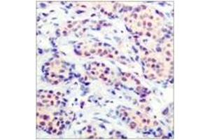 Immunohistochemistry analysis of paraffin-embedded human breast carcinoma tissue, using JunD (Ab-255) Antibody. (JunD antibody  (AA 222-271))
