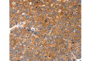Immunohistochemical analysis of paraffin-embedded Human liver cancer tissue using at dilution 1/20. (FGF3 antibody  (C-Term))