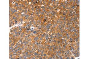Immunohistochemical analysis of paraffin-embedded Human liver cancer tissue using at dilution 1/20. (FGF3 antibody  (C-Term))