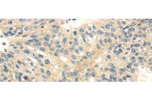 Immunohistochemistry of paraffin-embedded Human breast cancer tissue using CD70 Polyclonal Antibody at dilution 1:40 (CD70 antibody)