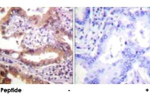 Immunohistochemical analysis of paraffin-embedded human lung carcinoma tissue using IRF3 polyclonal antibody .