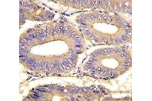 IHC analysis of FFPE human colon carcinoma tissue stained with PAK1 antibody (PAK1 antibody  (AA 401-430))
