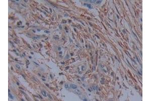 Detection of PLS3 in Human Colorectal cancer Tissue using Polyclonal Antibody to Plastin 3 (PLS3) (Plastin 3 antibody  (AA 379-630))
