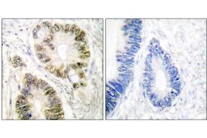 Immunohistochemical analysis of paraffin-embedded human colon carcinoma tissue using Cyclin E1 (phospho-Thr395) antibody.