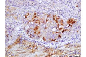 Formalin-fixed and paraffin embedded human gastric carcinoma labeled with Rabbit Anti-PRDX5 Polyclonal Antibody, Unconjugated  at 1:200 followed by conjugation to the secondary antibody and DAB staining (Peroxiredoxin 5 antibody  (AA 141-214))