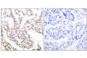 Immunohistochemical analysis of paraffin-embedded human breast carcinoma tissue using Elk-1 (phospho-Thr417) antibody (E011038). (ELK1 antibody  (pThr417))