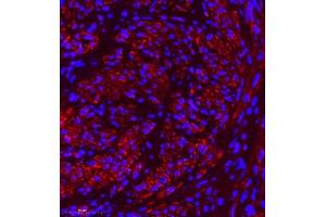 Immunofluorescence of paraffin embedded human cervical cancer using MYL6 (ABIN7074734) at dilution of 1:650 (400x lens) (MYL6 antibody)