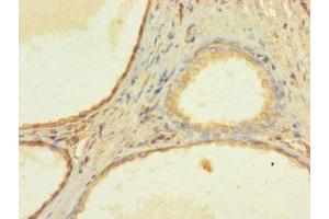 Immunohistochemistry of paraffin-embedded human prostate cancer using ABIN7176311 at dilution of 1:100 (ZNF432 antibody  (AA 1-260))