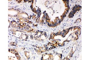 Anti-XIAP antibody, IHC(P) IHC(P): Human Intestinal Cancer Tissue (XIAP antibody  (N-Term))
