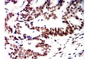 Immunohistochemical analysis of paraffin-embedded rectal cancer tissues using PMS2 mouse mAb with DAB staining. (PMS2 antibody)