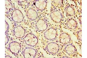 Immunohistochemistry of paraffin-embedded human colon cancer using ABIN7170823 at dilution of 1:100 (Striatin antibody  (AA 581-780))
