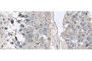 Immunohistochemistry of paraffin-embedded Human liver cancer tissue using NPHP1 Polyclonal Antibody at dilution of 1:60(x200) (NPHP1 antibody)