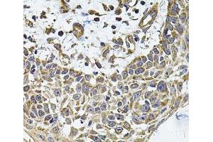 Immunohistochemistry of paraffin-embedded Human skin carcinoma using ICOSL Polyclonal Antibody at dilution of 1:100 (40x lens). (ICOSLG antibody)
