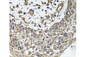 Immunohistochemistry of paraffin-embedded Human skin carcinoma using ICOSL Polyclonal Antibody at dilution of 1:100 (40x lens). (ICOSLG antibody)