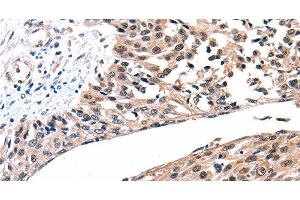 Immunohistochemistry of paraffin-embedded Human esophagus cancer tissue using Connexin-26 Polyclonal Antibody at dilution 1:100 (GJB2 antibody)