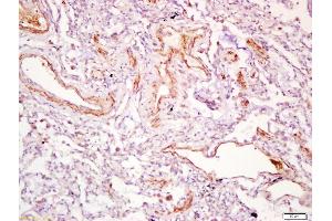 Formalin-fixed and paraffin embedded human lung carcinoma labeled with Anti-PDGF-D Polyclonal Antibody, Unconjugated (ABIN714581) at 1:200 followed by conjugation to the secondary antibody and DAB staining (PDGFD antibody  (AA 271-370))