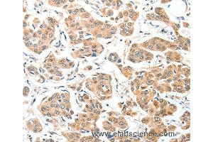 Immunohistochemistry of Human thyroid cancer using ADCK1 Polyclonal Antibody at dilution of 1:40 (ADCK1 antibody)