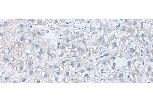 Immunohistochemistry of paraffin-embedded Human liver cancer tissue using ATP6V1C1 Polyclonal Antibody at dilution of 1:100(x200)