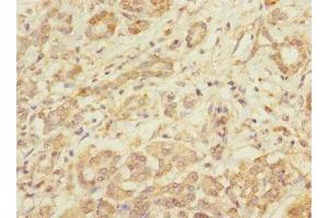 Immunohistochemistry of paraffin-embedded human pancreatic cancer using ABIN7173550 at dilution of 1:100 (Tropomodulin 1 antibody  (AA 1-359))