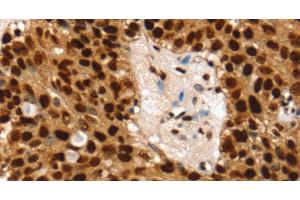 Immunohistochemistry of paraffin-embedded Human breast cancer using SSB Polyclonal Antibody at dilution of 1:30 (SSB antibody)