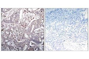 Immunohistochemical analysis of paraffin-embedded human breast carcinoma tissue, using IκB-β (Ab-23) antibody (E021304). (NFKBIB antibody)