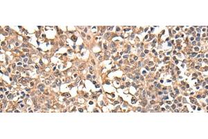 Immunohistochemistry of paraffin-embedded Human tonsil tissue using ATRIP Polyclonal Antibody at dilution of 1:40(x200)
