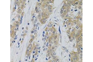 Immunohistochemistry of paraffin-embedded Human prostate cancer using DNM2 Polyclonal Antibody (DNM2 antibody)