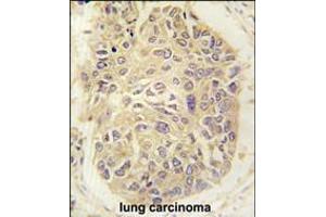 Formalin-fixed and paraffin-embedded human lung carcinoma tissue reacted with FARSA antibody , which was peroxidase-conjugated to the secondary antibody, followed by DAB staining. (Phenylalanyl-tRNA Synthetase, alpha Subunit (FARSA) (AA 54-83), (N-Term) antibody)