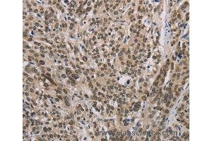 Immunohistochemistry of Human esophagus cancer using IRF9 Polyclonal Antibody at dilution of 1:50