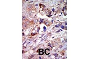 Formalin-fixed and paraffin-embedded human cancer tissue reacted with the primary antibody, which was peroxidase-conjugated to the secondary antibody, followed by AEC staining. (MAP3K12 antibody  (C-Term))