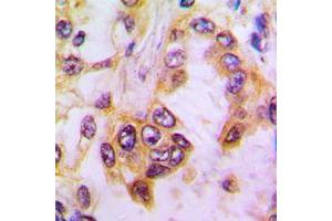 Immunohistochemical analysis of Caspase 9 staining in human lung cancer formalin fixed paraffin embedded tissue section. (Caspase 9 antibody  (Center))