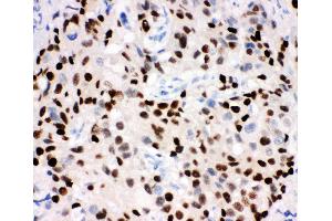 Anti-Progesterone Receptor Picoband antibody,  IHC(P): Human Mammary Cancer Tissue (Progesterone Receptor antibody  (AA 595-933))