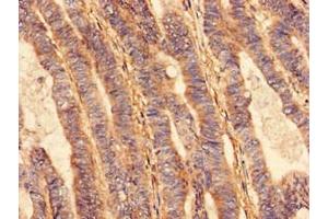 Immunohistochemistry analysis of human colon cancer using ABIN7175296 at dilution of 1:100 (VPS26B antibody  (AA 1-336))