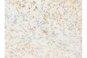 ABIN7095868 and ABIN7099930 at 1/100 staining human tongue carcinoma by IHC-P. (MCAF1 antibody)