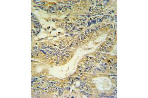 PYY Antibody IHC analysis in formalin fixed and paraffin embedded colon carcinoma followed by peroxidase conjugation of the secondary antibody and DAB staining. (Peptide YY antibody  (C-Term))