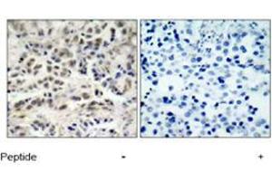 Immunohistochemical analysis of paraffin-embedded human lung carcinoma tissue using CDKN1B polyclonal antibody  . (CDKN1B antibody  (Ser10))