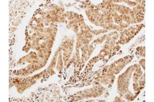 IHC-P Image Immunohistochemical analysis of paraffin-embedded OVCA xenograft, using LIMD1, antibody at 1:300 dilution.