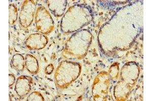 Immunohistochemistry of paraffin-embedded human gastric cancer using ABIN7142369 at dilution of 1:100 (MRPL2 antibody  (AA 61-305))