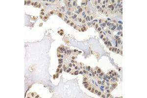 Immunohistochemistry of paraffin-embedded human thyroid cancer using GTF2F1 antibody (ABIN5971324) at dilution of 1/200 (40x lens). (GTF2F1 antibody)