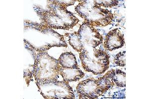 IHC analysis of Carbonic Anhydrase 9/CA9 using anti-Carbonic Anhydrase 9/CA9 antibody (ABIN7600076).