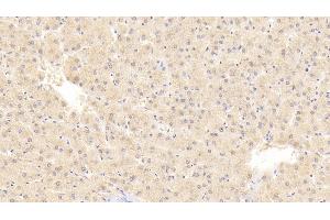 Immunohistochemistry (IHC) image for anti-Preferentially Expressed Antigen in Melanoma (PRAME) (AA 416-502) antibody (ABIN7437779)