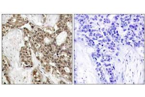 Immunohistochemical analysis of paraffin-embedded human breast carcinoma tissue, using p44/42 MAP Kinase (phospho-Tyr204) antibody (E011246). (ERK1/2 antibody  (pTyr204))
